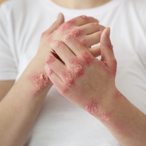 hands-patient-suffering-from-psoriasis (1)