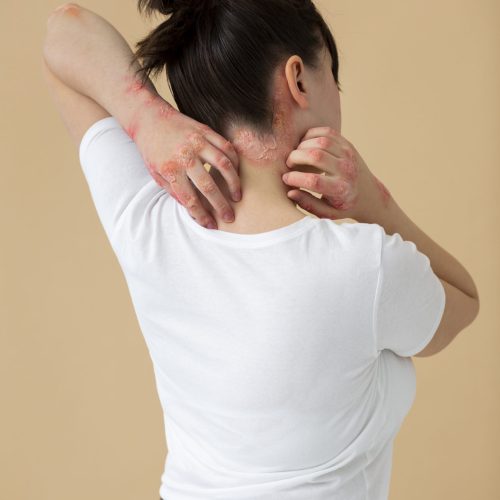 psoriasis-eczema-neck-patient