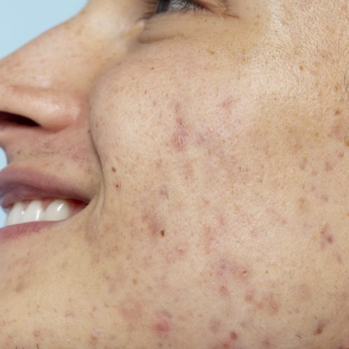 side-view-smiley-man-with-skin-problems